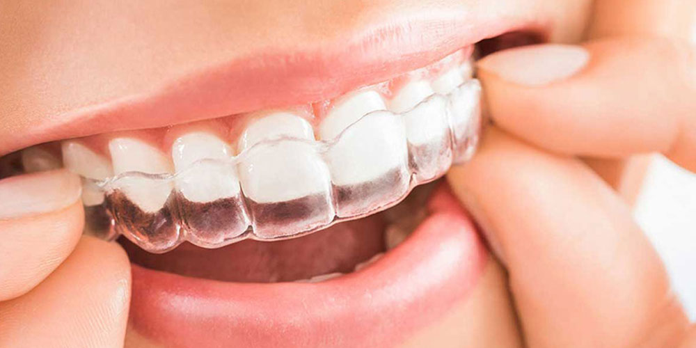 Ortodonzia invisibile: un nuovo sorriso con l’apparecchio trasparente.