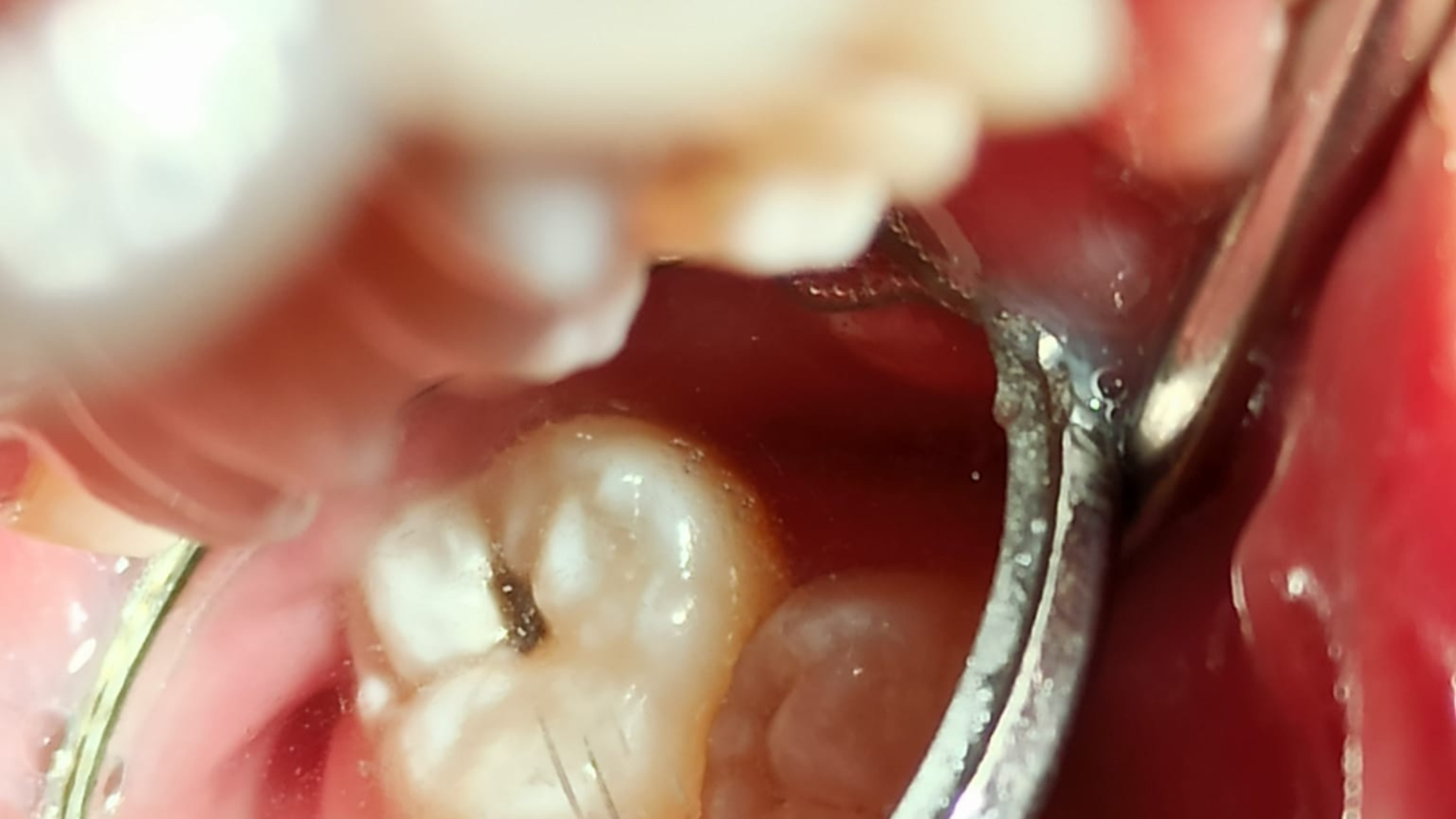 Carie dentale: come si cura e come evitarla